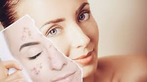 Insightful post about using home remedies to remove scars
