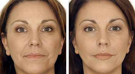 After the facelift,santa Barbara women look younger