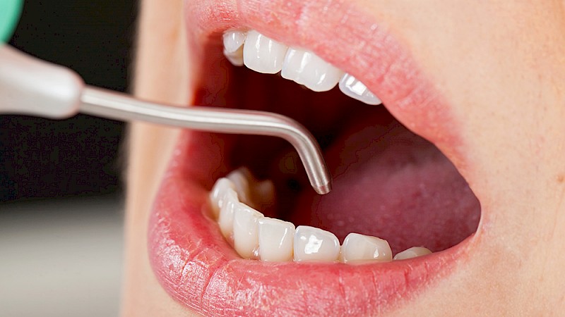 Remove tartar (Zahnsteinentfernen) should be done immediately so that the damage does not get worse over time